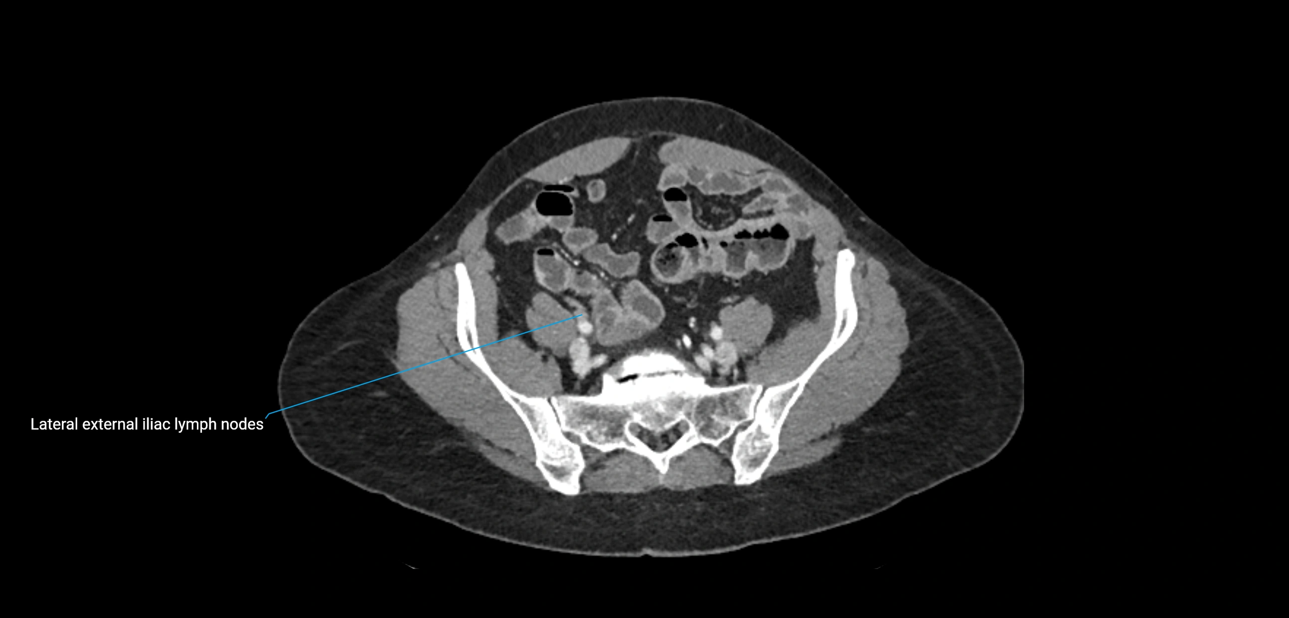 CT ct abdominal lymph nodes  axial cross sectional anatomy  enchanced radiology image -img-00002-00321.webp